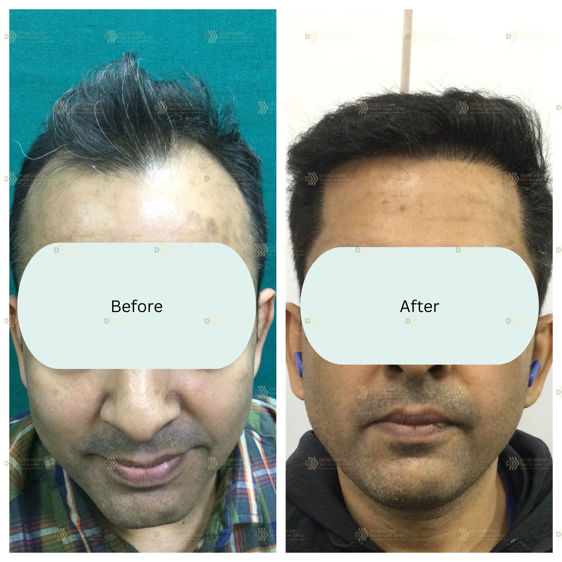 Before and after result