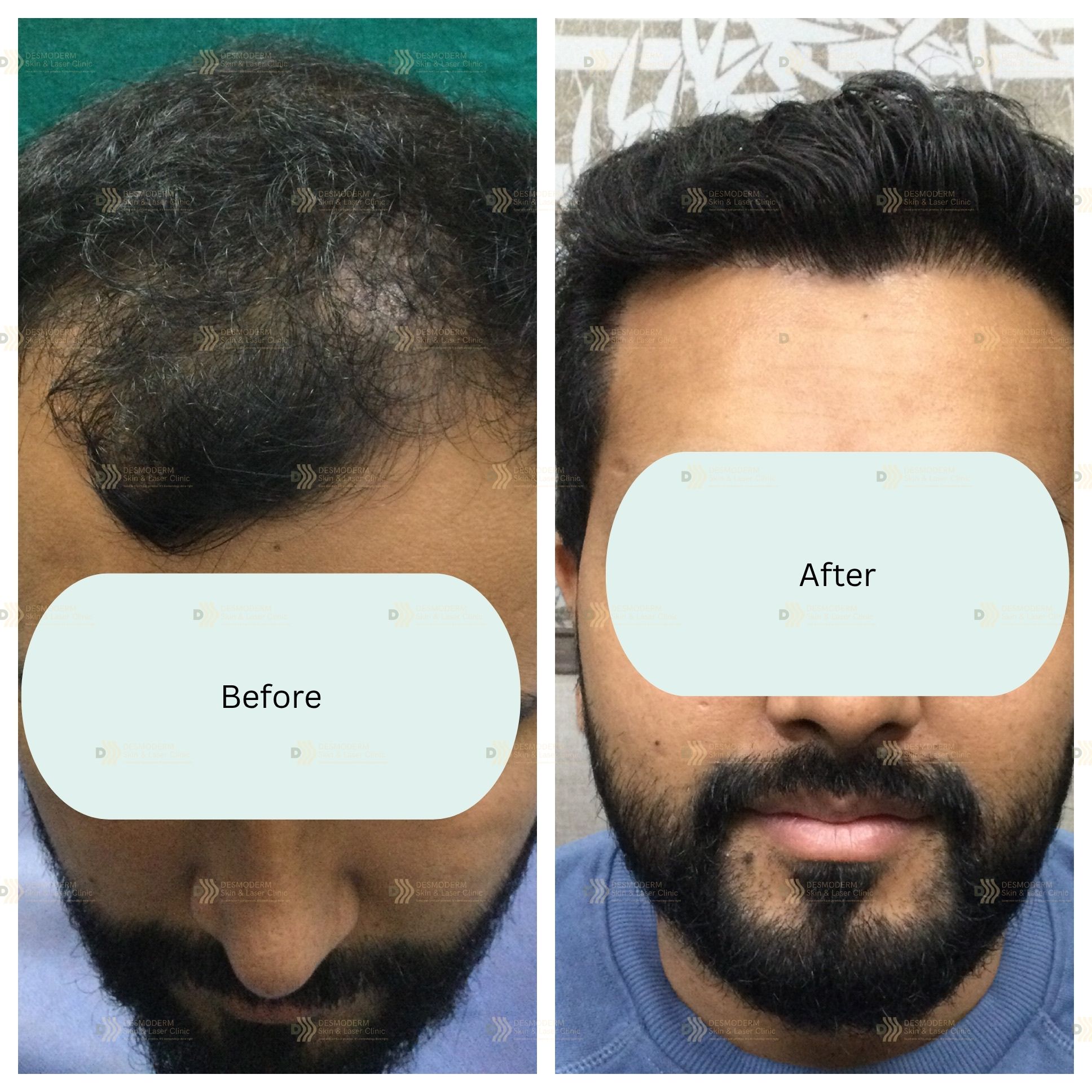 Before and after result