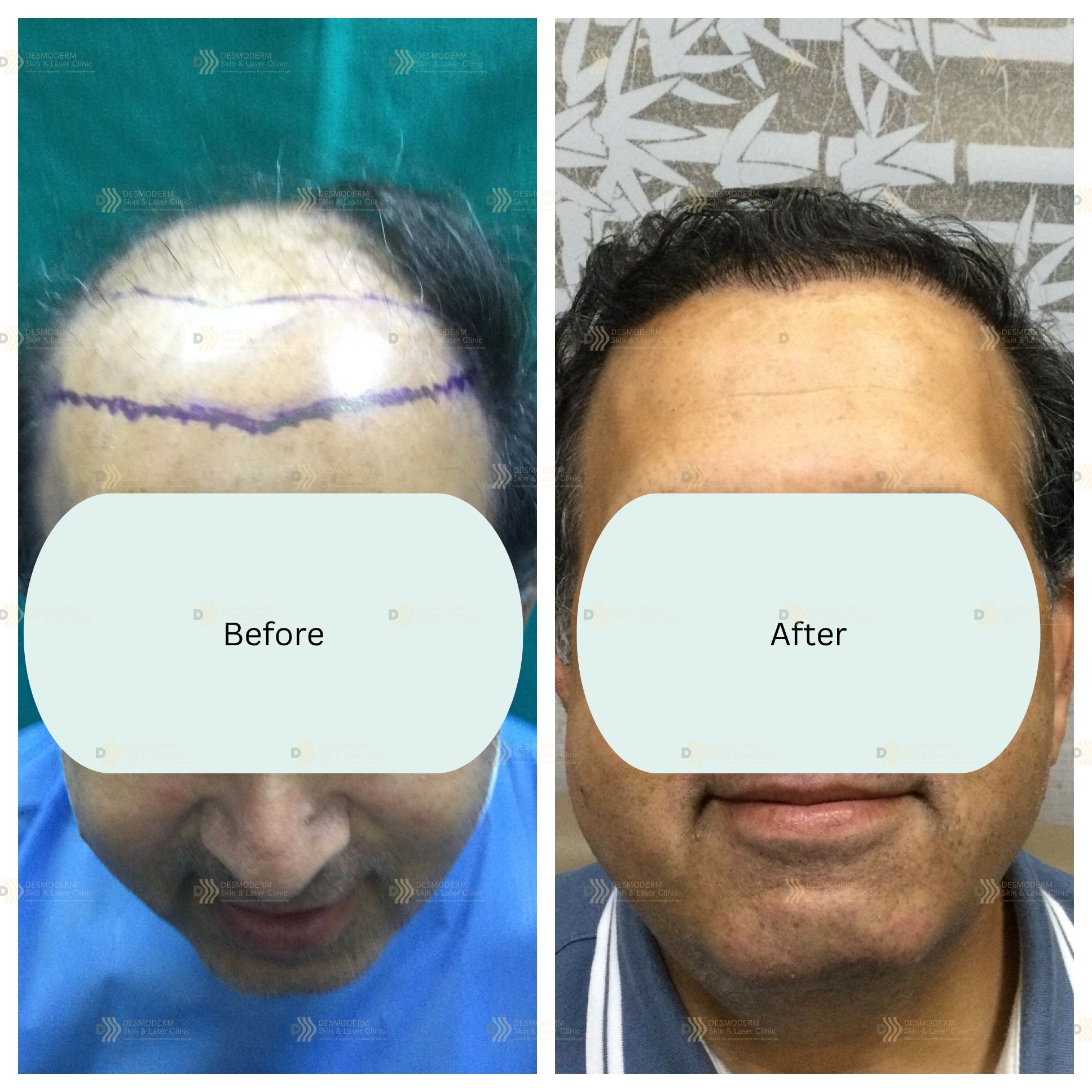 Before and after result